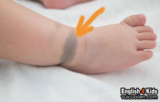 Vết bớt tiếng anh là gì